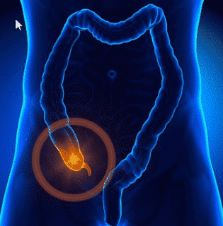Appendix Linked To Toxic Parkinson’s Protein Health Editor’s Note: Should we all have our appendixes removed, like prophylactically? Speaking of having appendixes removed, I had (well still have but he is not so young now) a very young son who said his stomach hurt and it was not the usua...