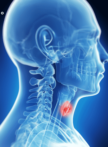 thyroid cancer 2