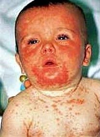measles