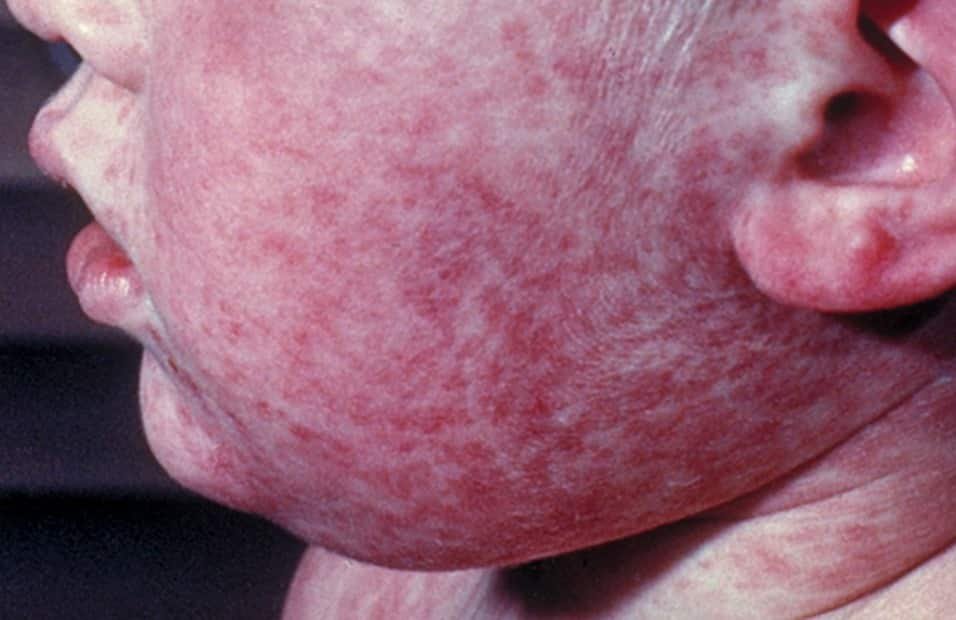 measles (2)